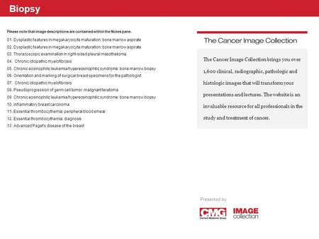 Biopsy Please note that image descriptions are contained within the Notes pane. 01. Dysplastic features in megakaryocyte maturation: bone marrow aspirate.