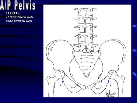 12 11 DOTS 11 Pelvic-Sacral Dots and 3 Vertebral Dots.