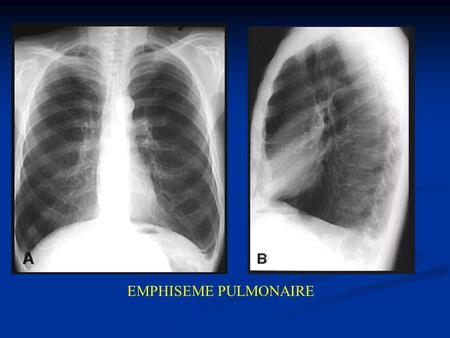 EMPHISEME PULMONAIRE.