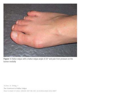 Wülker, N; Mittag, F The Treatment of Hallux Valgus Dtsch Arztebl Int 2012; 109(49): 857-68; DOI: 10.3238/arztebl.2012.0857.