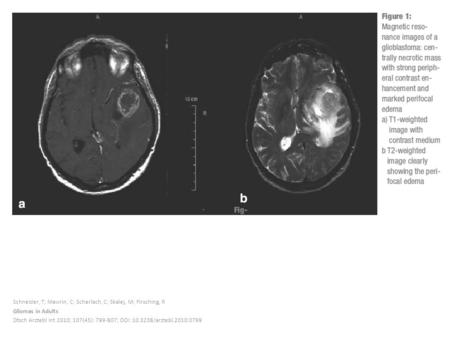 Schneider, T; Mawrin, C; Scherlach, C; Skalej, M; Firsching, R Gliomas in Adults Dtsch Arztebl Int 2010; 107(45): 799-807; DOI: 10.3238/arztebl.2010.0799.