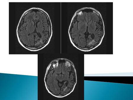 AM Report May 4, 2009 Amy Auerbach  Severe demyelinating disease of the central nervous system caused by reactivation of the polyomavirus JC  Occurs.