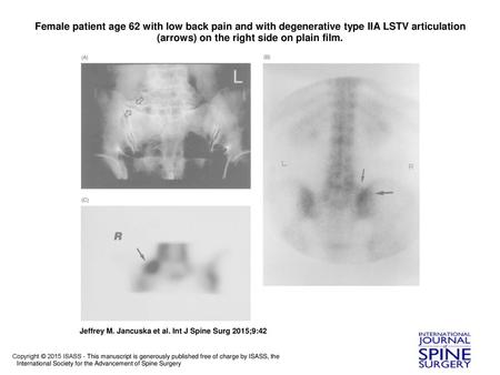 Female patient age 62 with low back pain and with degenerative type IIA LSTV articulation (arrows) on the right side on plain film. Female patient age.