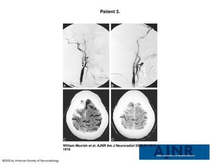 Patient 3. Patient 3. A, Ninety-nine percent right internal carotid artery stenosis. A left external carotid stent is also visualized. The left internal.