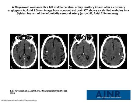 A 70-year-old woman with a left middle cerebral artery territory infarct after a coronary angiogram.A, Axial 2.5-mm image from noncontrast brain CT shows.