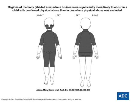 Regions of the body (shaded area) where bruises were significantly more likely to occur in a child with confirmed physical abuse than in one where physical.