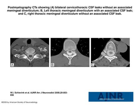 Postmyelography CTs showing (A) bilateral cervicothoracic CSF leaks without an associated meningeal diverticulum; B, Left thoracic meningeal diverticulum.