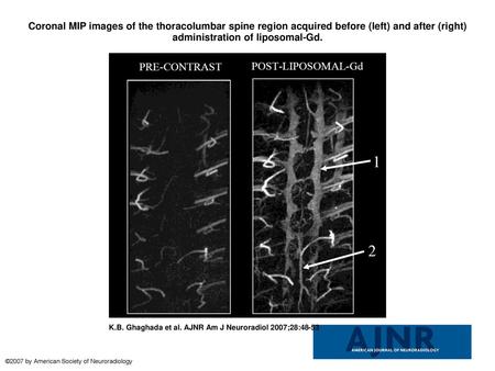 Coronal MIP images of the thoracolumbar spine region acquired before (left) and after (right) administration of liposomal-Gd. Coronal MIP images of the.