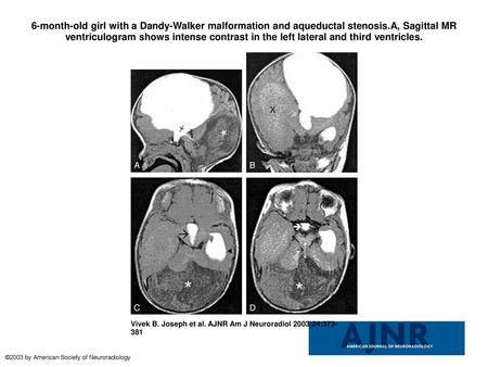 6-month-old girl with a Dandy-Walker malformation and aqueductal stenosis.A, Sagittal MR ventriculogram shows intense contrast in the left lateral and.