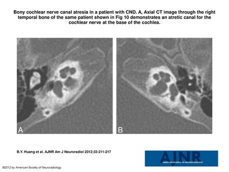 Bony cochlear nerve canal atresia in a patient with CND