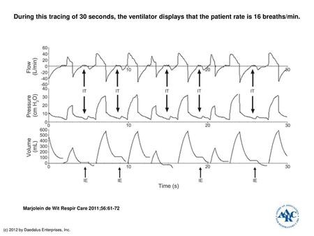 During this tracing of 30 seconds, the ventilator displays that the patient rate is 16 breaths/min. During this tracing of 30 seconds, the ventilator displays.