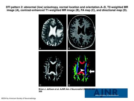 DTI pattern 2: abnormal (low) anisotropy, normal location and orientation.A–D, T2-weighted MR image (A), contrast-enhanced T1-weighted MR image (B), FA.