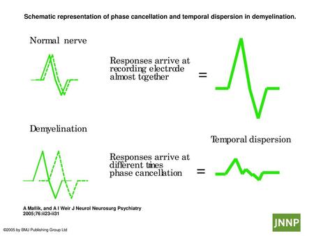  Schematic representation of phase cancellation and temporal dispersion in demyelination.  Schematic representation of phase cancellation and temporal.