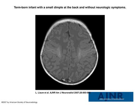 Term-born infant with a small dimple at the back and without neurologic symptoms. Term-born infant with a small dimple at the back and without neurologic.