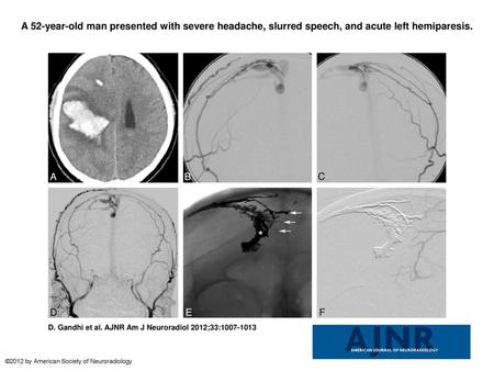 A 52-year-old man presented with severe headache, slurred speech, and acute left hemiparesis. A 52-year-old man presented with severe headache, slurred.