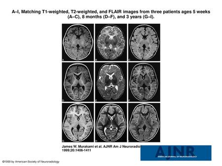 A–I, Matching T1-weighted, T2-weighted, and FLAIR images from three patients ages 5 weeks (A–C), 8 months (D–F), and 3 years (G–I). A–I, Matching T1-weighted,