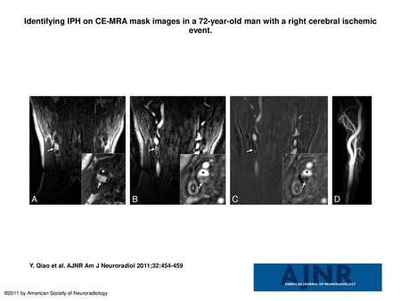 Identifying IPH on CE-MRA mask images in a 72-year-old man with a right cerebral ischemic event. Identifying IPH on CE-MRA mask images in a 72-year-old.