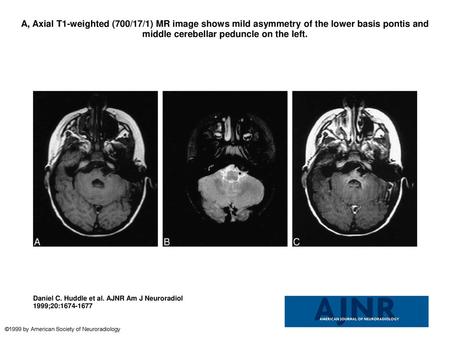 A, Axial T1-weighted (700/17/1) MR image shows mild asymmetry of the lower basis pontis and middle cerebellar peduncle on the left. A, Axial T1-weighted.