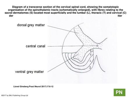 Diagram of a transverse section of the cervical spinal cord, showing the somatotopic organisation of the spinothalamic tracts (schematically enlarged),