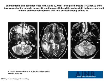 Supratentorial and posterior fossa PML