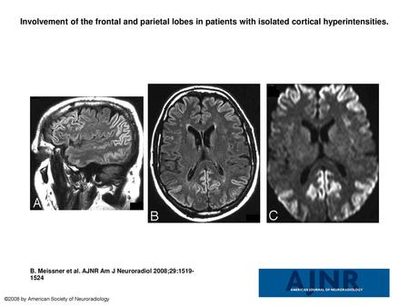 Involvement of the frontal and parietal lobes in patients with isolated cortical hyperintensities. Involvement of the frontal and parietal lobes in patients.