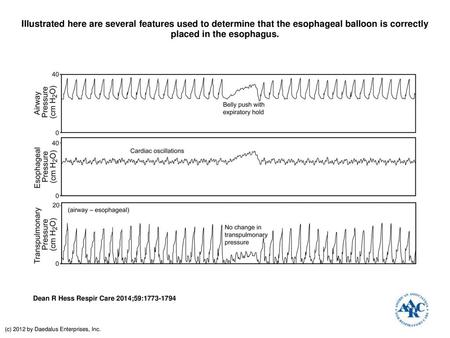 Illustrated here are several features used to determine that the esophageal balloon is correctly placed in the esophagus. Illustrated here are several.