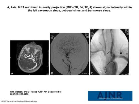 A, Axial MRA maximum intensity projection (MIP) (TR, 34; TE, 4) shows signal intensity within the left cavernous sinus, petrosal sinus, and transverse.