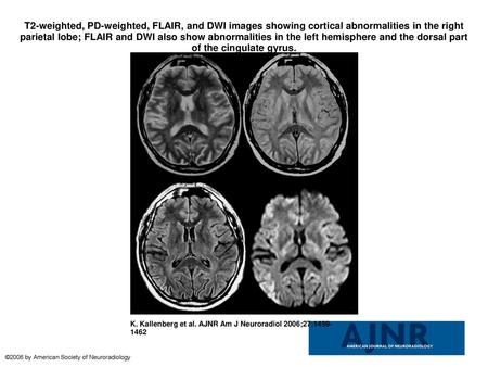 T2-weighted, PD-weighted, FLAIR, and DWI images showing cortical abnormalities in the right parietal lobe; FLAIR and DWI also show abnormalities in the.