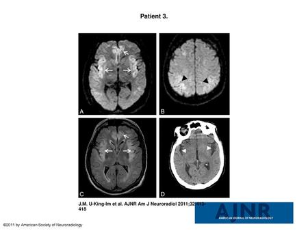 Patient 3. Patient 3. A 55-year-old man with severe sepsis of unknown origin (positive blood cultures for Enterococcus species) with a background of schizophrenia,