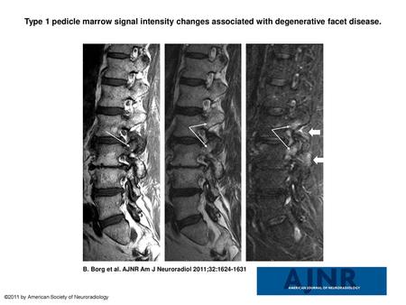 Type 1 pedicle marrow signal intensity changes associated with degenerative facet disease. Type 1 pedicle marrow signal intensity changes associated with.