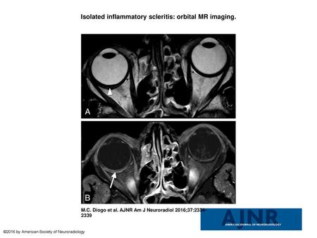 Isolated inflammatory scleritis: orbital MR imaging.