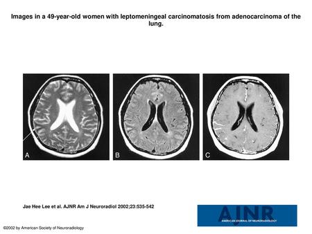 Images in a 49-year-old women with leptomeningeal carcinomatosis from adenocarcinoma of the lung. Images in a 49-year-old women with leptomeningeal carcinomatosis.