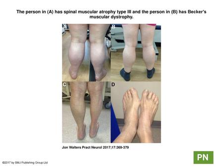 The person in (A) has spinal muscular atrophy type III and the person in (B) has Becker’s muscular dystrophy. The person in (A) has spinal muscular atrophy.