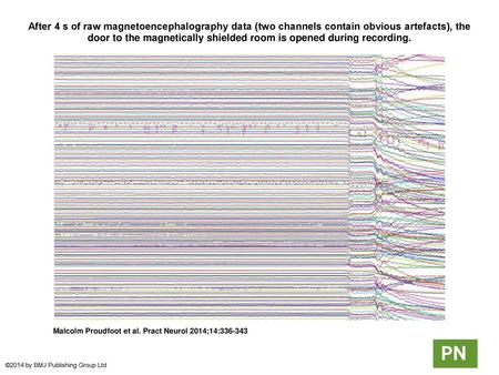 After 4 s of raw magnetoencephalography data (two channels contain obvious artefacts), the door to the magnetically shielded room is opened during recording.