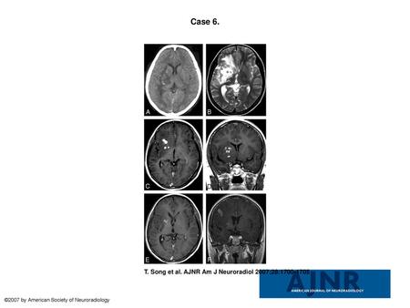 Case 6. Case 6. Images of the brain of a 14-year-old boy with a 4-year history of seizures and left hemiparesis. A, Precontrast CT scan shows an extensive.