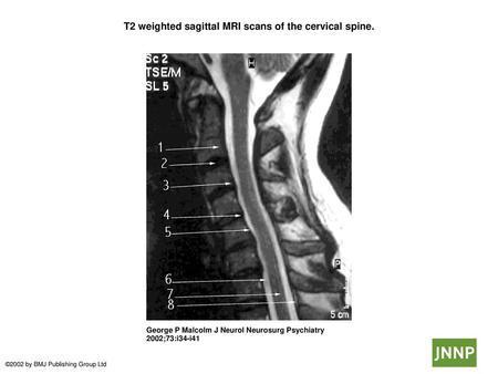 T2 weighted sagittal MRI scans of the cervical spine.