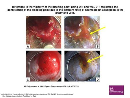 Difference in the visibility of the bleeding point using DRI and WLI