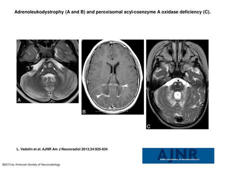 Adrenoleukodystrophy (A and B) and peroxisomal acyl-coenzyme A oxidase deficiency (C). Adrenoleukodystrophy (A and B) and peroxisomal acyl-coenzyme A oxidase.