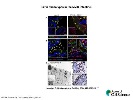 Ezrin phenotypes in the MVID intestine.