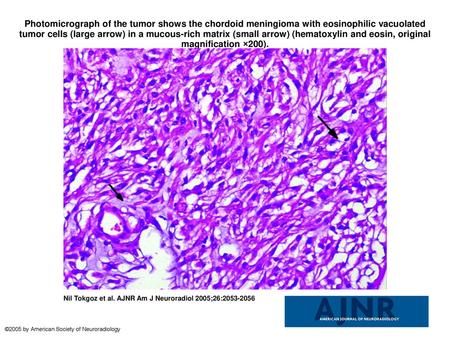 Photomicrograph of the tumor shows the chordoid meningioma with eosinophilic vacuolated tumor cells (large arrow) in a mucous-rich matrix (small arrow)