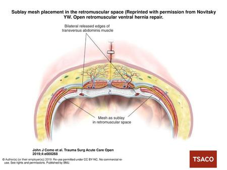 Sublay mesh placement in the retromuscular space (Reprinted with permission from Novitsky YW. Open retromuscular ventral hernia repair. Sublay mesh placement.