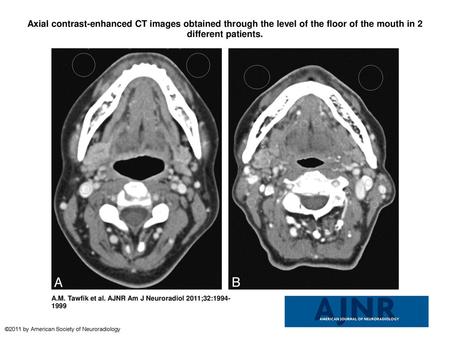 Axial contrast-enhanced CT images obtained through the level of the floor of the mouth in 2 different patients. Axial contrast-enhanced CT images obtained.