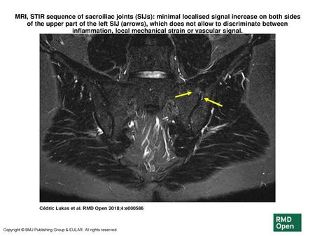 MRI, STIR sequence of sacroiliac joints (SIJs): minimal localised signal increase on both sides of the upper part of the left SIJ (arrows), which does.