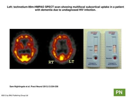 Left: technetium-99m-HMPAO SPECT scan showing multifocal subcortical uptake in a patient with dementia due to undiagnosed HIV infection. Left: technetium-99m-HMPAO.