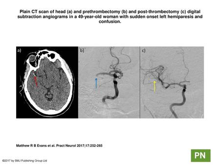 Plain CT scan of head (a) and prethrombectomy (b) and post-thrombectomy (c) digital subtraction angiograms in a 49-year-old woman with sudden onset left.