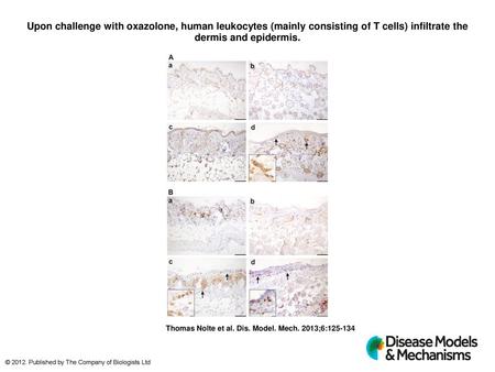 Upon challenge with oxazolone, human leukocytes (mainly consisting of T cells) infiltrate the dermis and epidermis. Upon challenge with oxazolone, human.