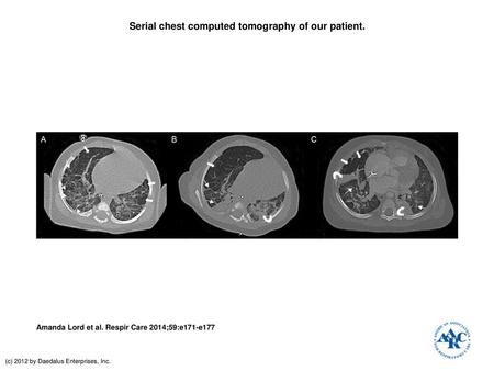 Serial chest computed tomography of our patient.