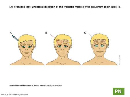 (A) Frontalis test: unilateral injection of the frontalis muscle with botulinum toxin (BoNT). (A) Frontalis test: unilateral injection of the frontalis.