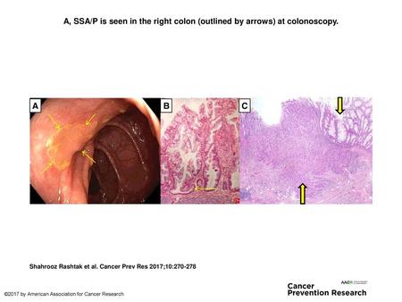 A, SSA/P is seen in the right colon (outlined by arrows) at colonoscopy. A, SSA/P is seen in the right colon (outlined by arrows) at colonoscopy. Note.