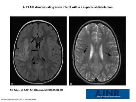 A, FLAIR demonstrating acute infarct within a superficial distribution